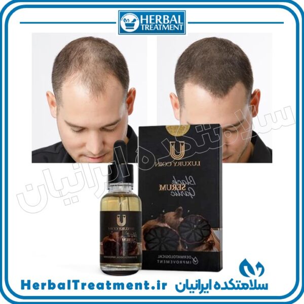 سرم سیر سیاه اصل - سلامتکده ایرانیان